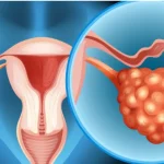 bilateral polycystic ovaries​