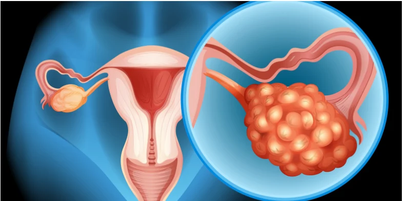 bilateral polycystic ovaries​